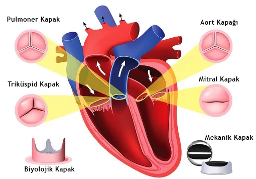Kalp Kapakçığı Hastalıklarında Cerrahi Ne Zaman Gerekir?